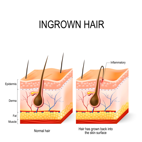 схема врастания волоса в поверхностный слой кожи